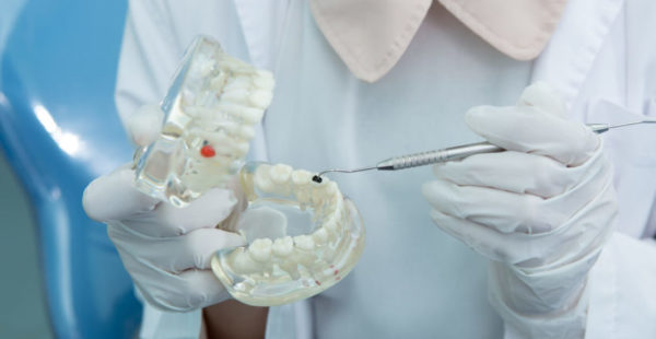 tratamento-de-caries-em-curitiba