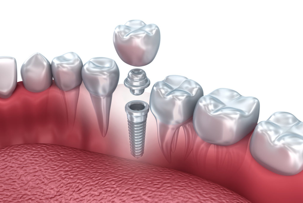 O que é e como evitar a peri-implantite