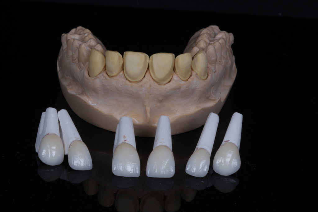 Selamento dentinário: conheça esta técnica