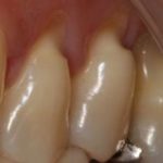 Lesão cervical não cariosa e o envelhecimento precoce dos dentes