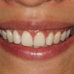 Gengivoplastia: seu sorriso mais bonito