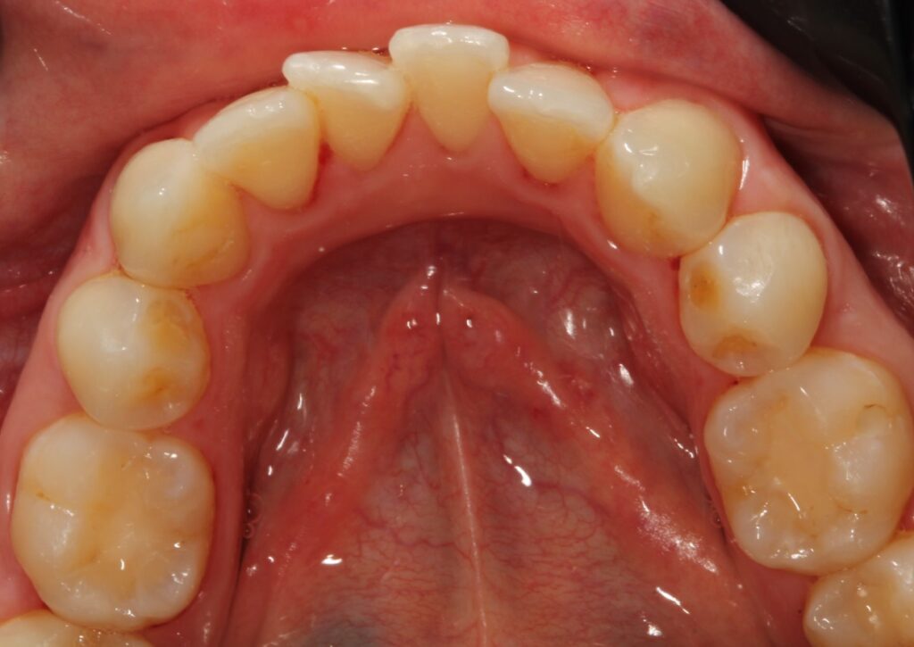 Apinhamento dentário: o que é e como tratar?