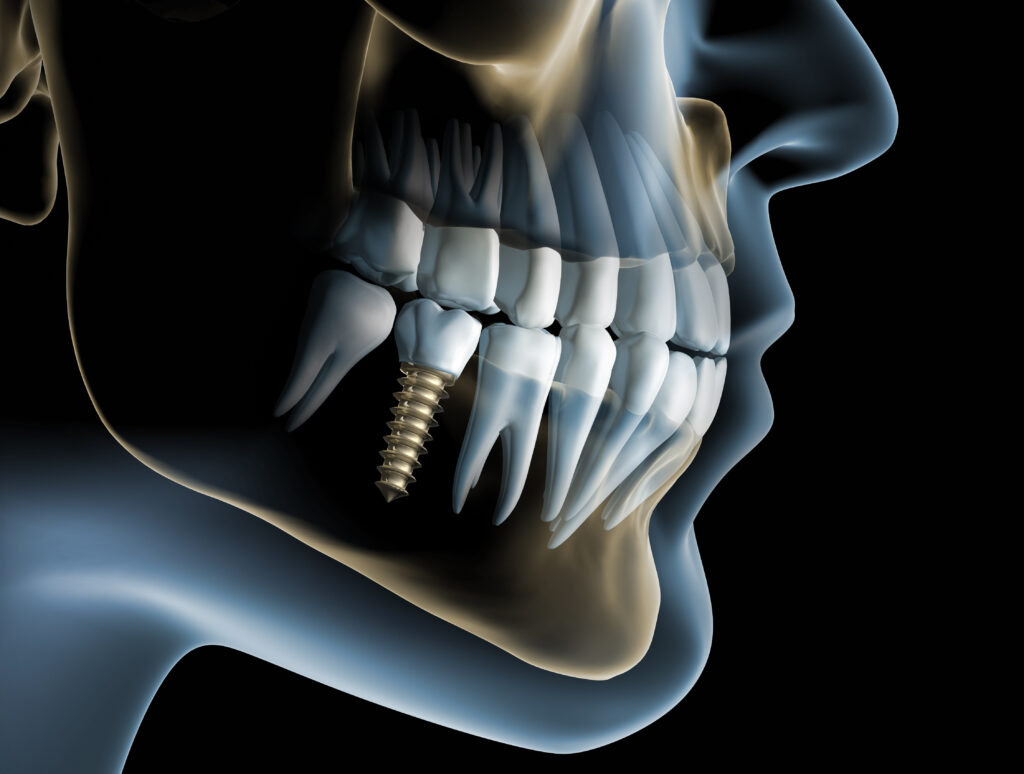 E-book Implante Dentário e Cirurgia Guiada