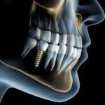 E-book Implante Dentário e Cirurgia Guiada