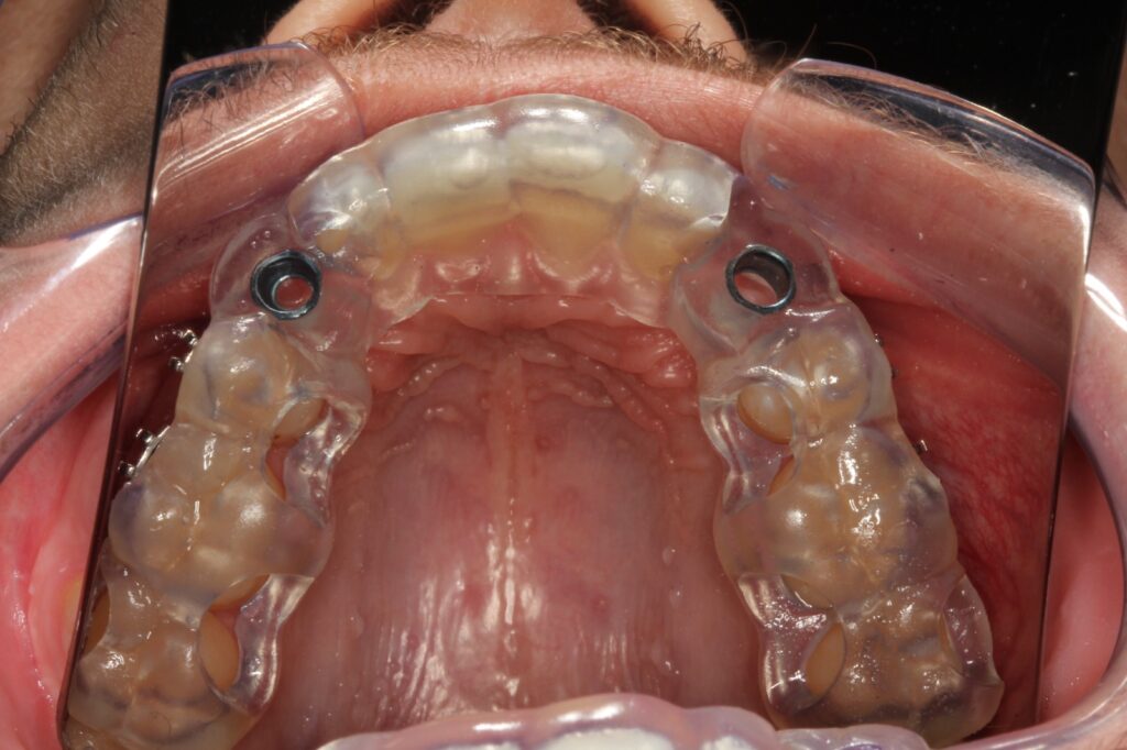 cirurgia guiada de implante dentário com aparelho