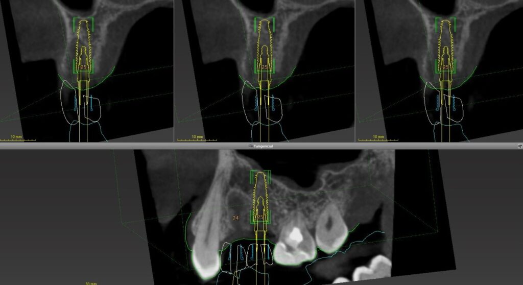 planejamento para cirurgia guiada de implante dentário