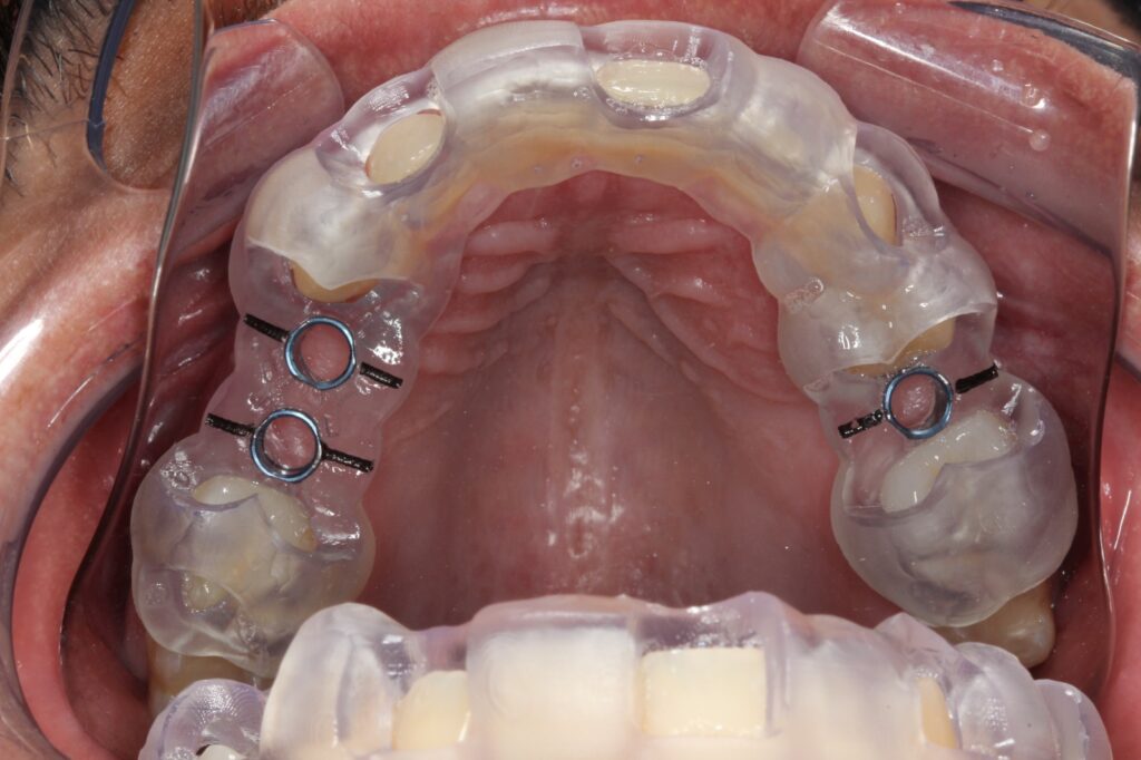 Cirurgia guiada de implante dentário: previsibilidade e segurança