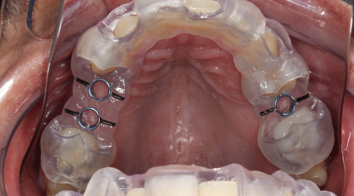 Cirurgia Guiada de Implante