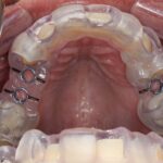 Cirurgia guiada de implante dentário: previsibilidade e segurança