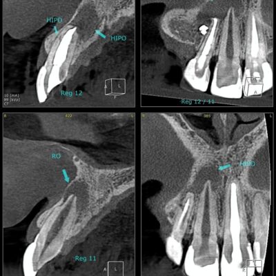 Você já ouviu falar em apicectomia?